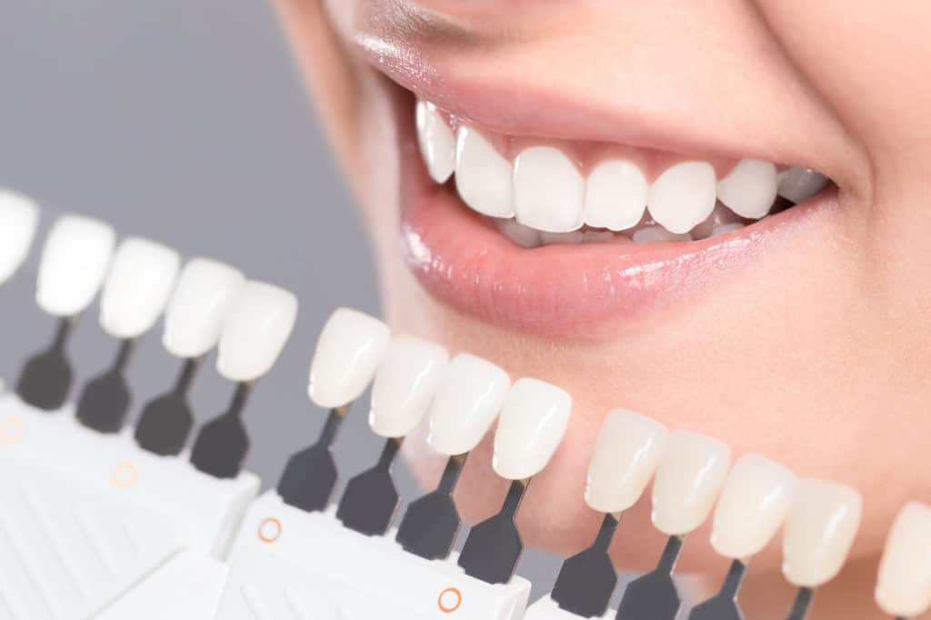 Professional Teeth Whitening Vs. Diy Whitening Kits