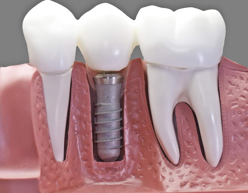 Different Types Of Dental Implants
