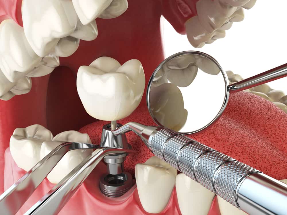 When Would Dental Implants Be Necessary?