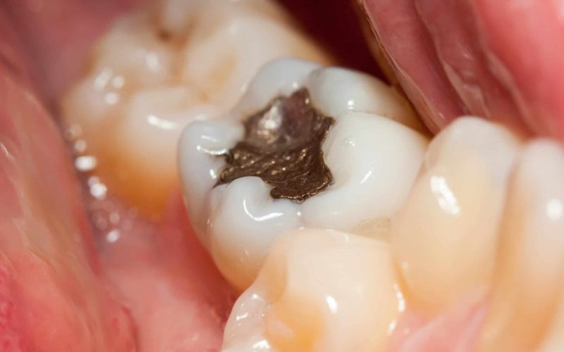 What Is A Tooth Filling?