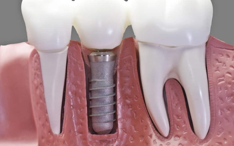 Different Types Of Dental Implants