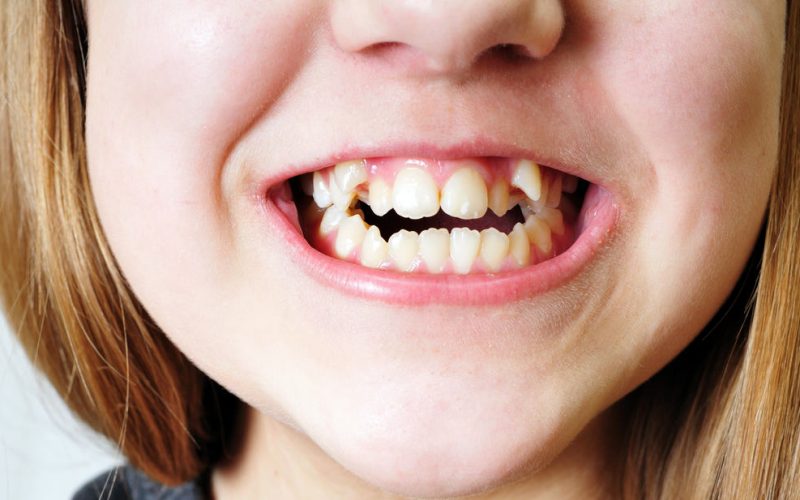 What Causes Crooked Teeth?
